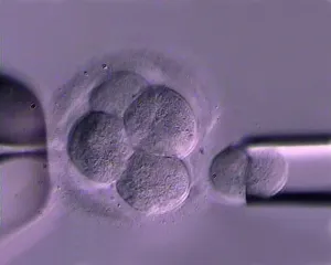 Do zapłodnienia wykorzystywane są komórki jajowe i plemniki o optymalnych parametrach, dających największe szanse na to, że zarodek, który powstanie będzie rozwijał się prawidłowo. Na zdjęciu pobranie komórki jajowej.