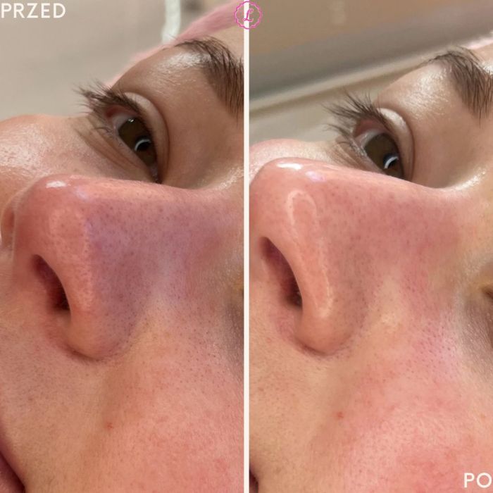 Powiększanie ust/Mezoterapia/Oczyszczanie wodorowe i inne: zdjecie 98235359