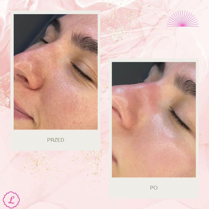 Powiększanie ust/Mezoterapia/Oczyszczanie wodorowe i inne: zdjecie 98235361