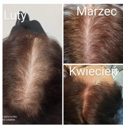 Efekty leczenia trychologicznego 