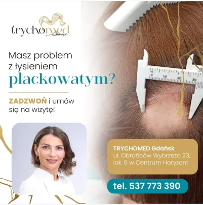 do kogo z łysieniem plackowatym 