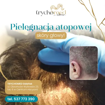 najlepszy trycholog w trojmiescie