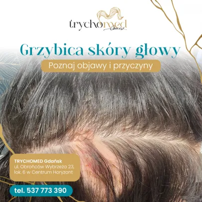 Grzybica skóry głowy 