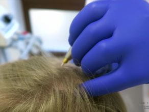 Kriomasaż skóry głowy - leczenie wypadania włosów i łysienia