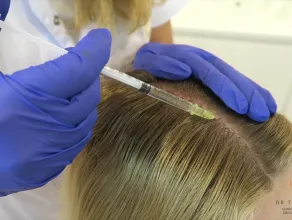 Mezoterapia Igłowa skóry głowy - mezoterapia na wypadanie włosów i łysienie
