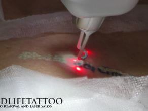 Tatuaż konturowy, usuwanie laserowe