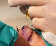 Usuwanie zmian skórnych i plastyka powiek  –  Odmień swoje spojrzenie w Centrum Medycznym ARR