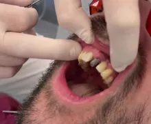 Implant jedynki
