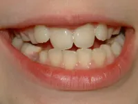 Wraca lakowanie zębów u dzieci