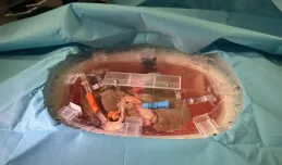Pierwsza taka transplantacja wątroby w historii UCK