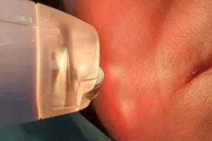 Moc dwóch laserów w jednym urządzeniu