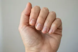 Białe plamki na paznokciach? Sprawdź, skąd się biorą