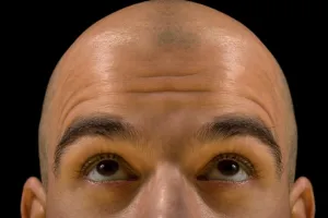 Porada dermatologa. Łysienie