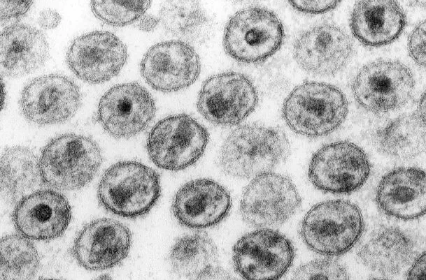 Zdjęcie wirusów HIV-1 wykonane mikroskopem elektronowym.