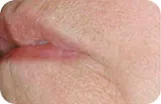 Po zabiegu