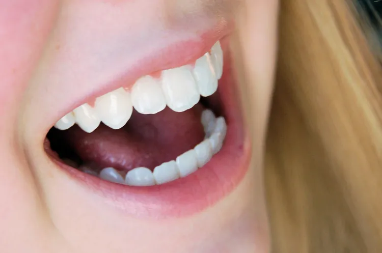 Licówki są coraz popularniejszą formą korekty defektów stomatologicznych. 