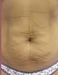 Przed zabiegiem