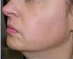 Po zabiegu