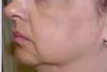 Przed zabiegiem