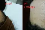Zabieg usuwania przebarwień, zupełnie bezbolesny dla pacjenta.