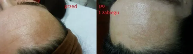Zabieg usuwania przebarwień, zupełnie bezbolesny dla pacjenta.