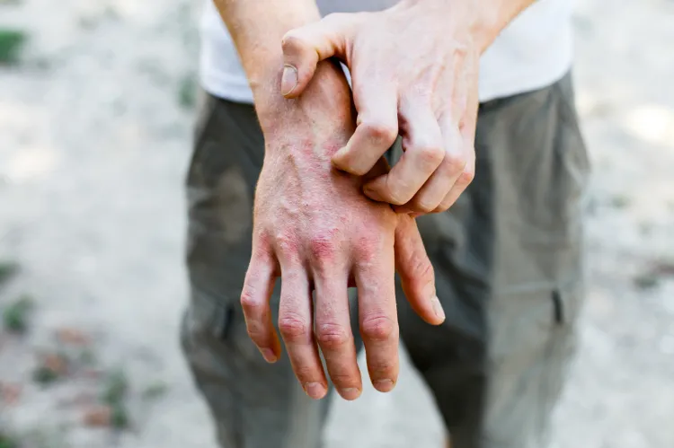 Osoby chorujące na atopowe zapalenie skóry często dotyka społeczne wykluczenie. Tymczasem choroba ma podłoże genetyczne i nie można się nią zarazić, np. poprzez dotyk czy uściśnięcie chorobowo zmienionej dłoni. 