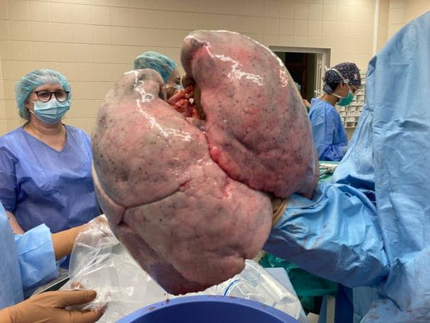 Lekarze z UCK po raz drugi przeprowadzili przeszczep płuc u pacjenta, którego narząd został zniszczony przez COVID-19. 