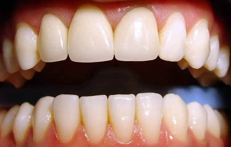 Licówki przykleja się na przednią powierzchnię zębów