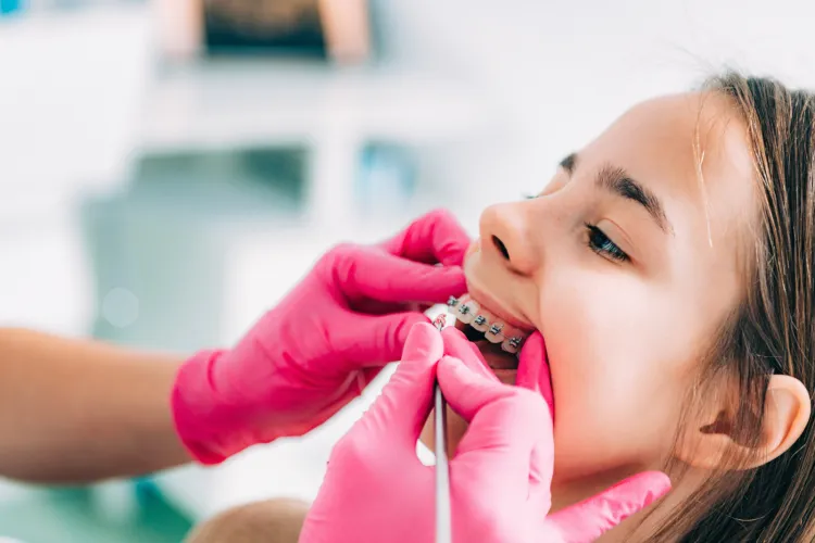 Specjaliści podkreślają, że w zależności od stopnia zaawansowania wady stałe aparaty ortodontyczne można stosować już u dzieci od 7-9 roku życia